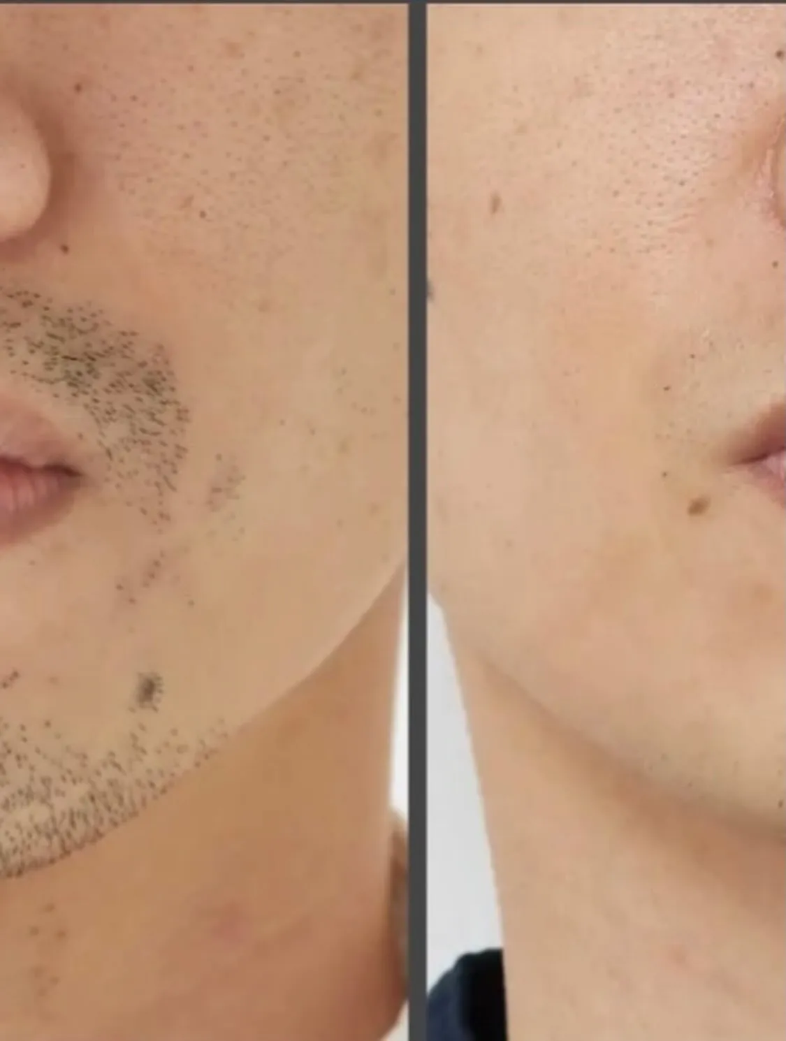 脱毛メニューがスタートしました‼️